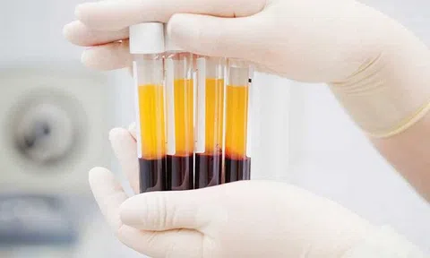 Làm đẹp bằng huyết tương giàu tiểu cầu có an toàn?